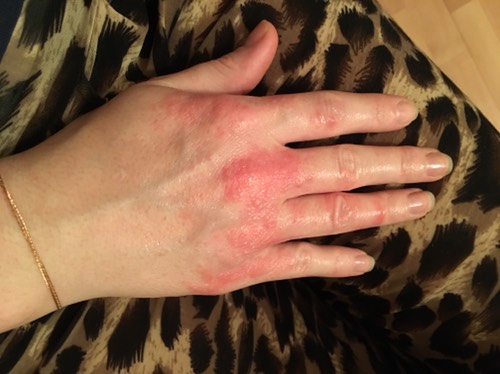 Что делать, если возникла аллергия на медицинские перчатки?