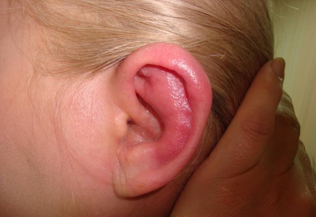 Аллергия на ушах