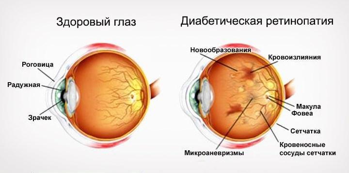 Диабетическая ретинопатия схематично