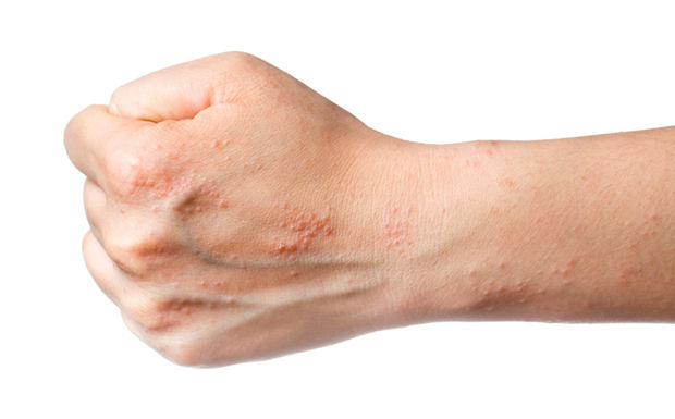 Аллергия на руках: симптомы, лечение и профилактика