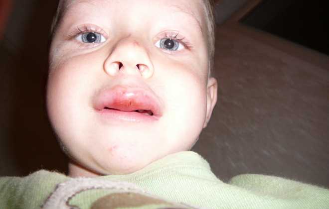 Разбитая опухшая губа у ребенка