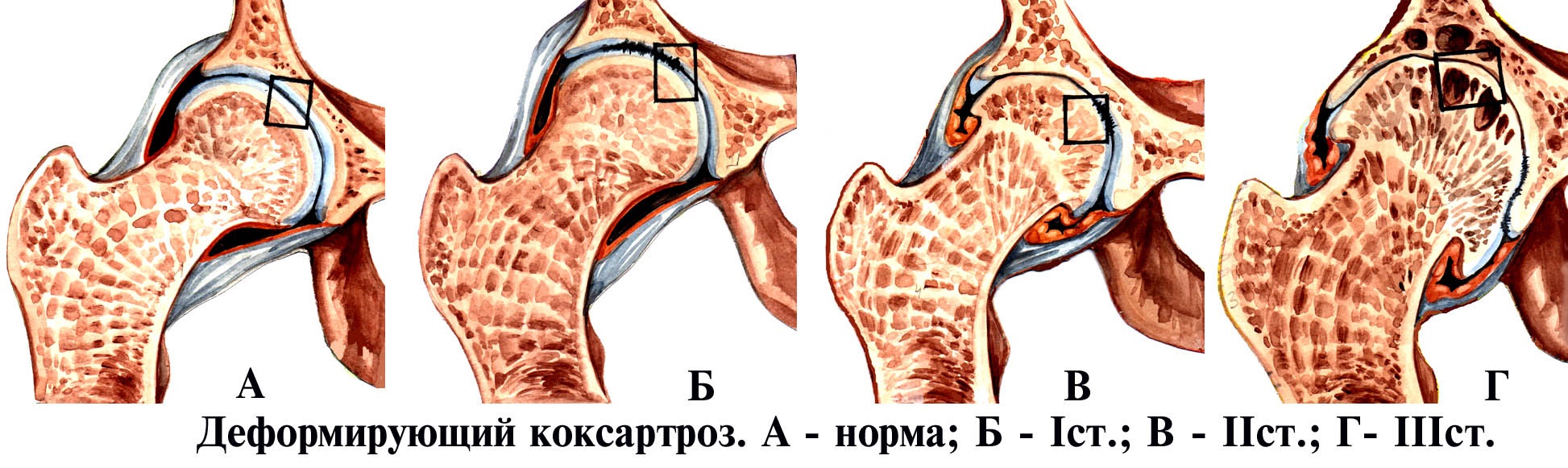 Деформирующий остеоартроз (ДОА) тазобедренного сустава 2 степени: что это такое и как лечить