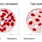 Болят глаза как будто давят и болит голова причины и что делать?