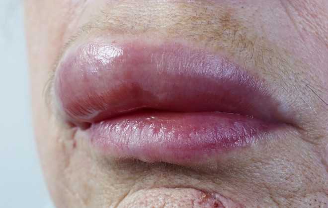 Аллергический отек верхней губы