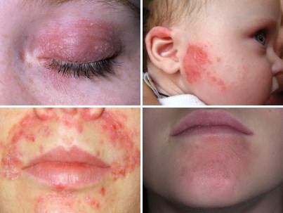 Аллергия на Новокаин