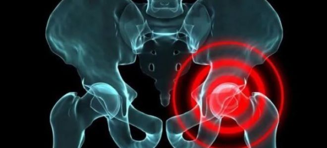 Боли в тазобедренном суставе с правой стороны: причины, симптомы и лечение