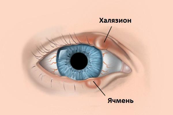 Халязион и ячмень глаза
