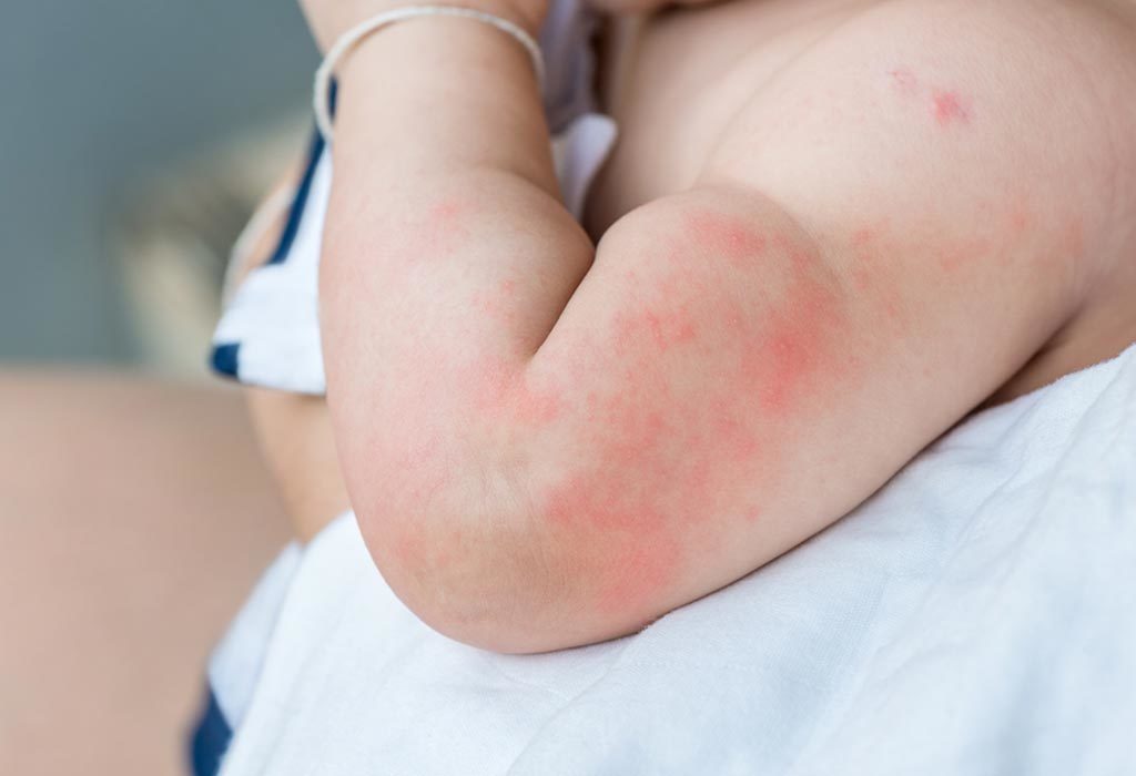 красная сыпь у ребенка на руке при аллергии