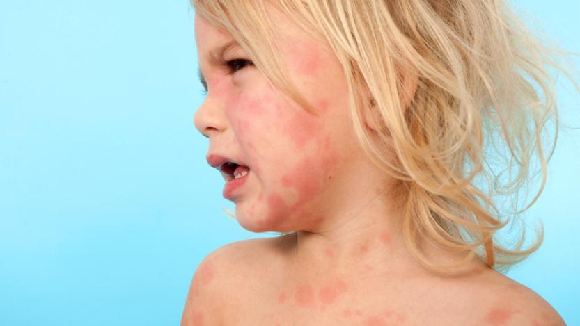 Что делать при внезапно возникшей аллергии у взрослого или ребёнка?