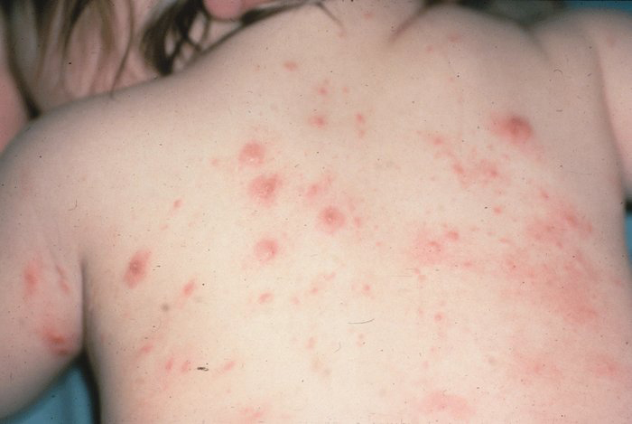 Аллергия на Цефтриаксон