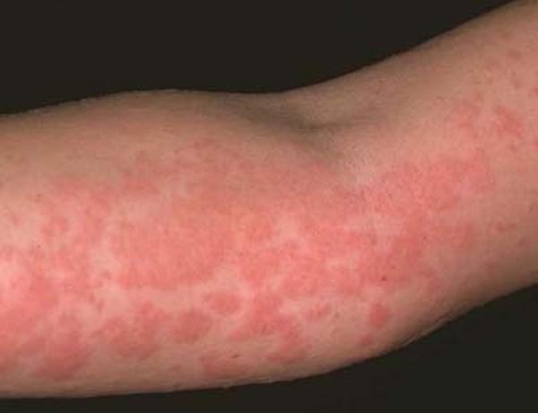 Аллергия на Флемоксин Солютаб