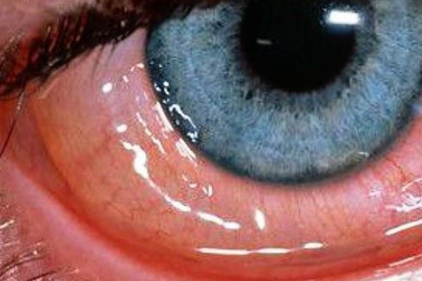 Аденовирусный конъюнктивит глаза