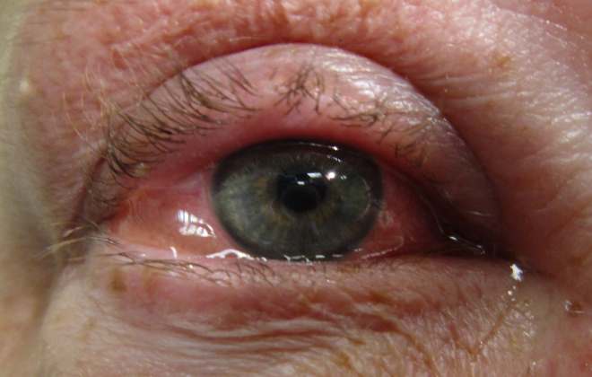 Отек роговицы глаза после операции