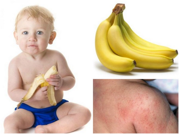 Аллергия на бананы у детей