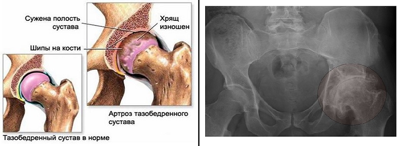 Внутрисуставные инъекции гиалуроновой кислоты в тазобедренный сустав