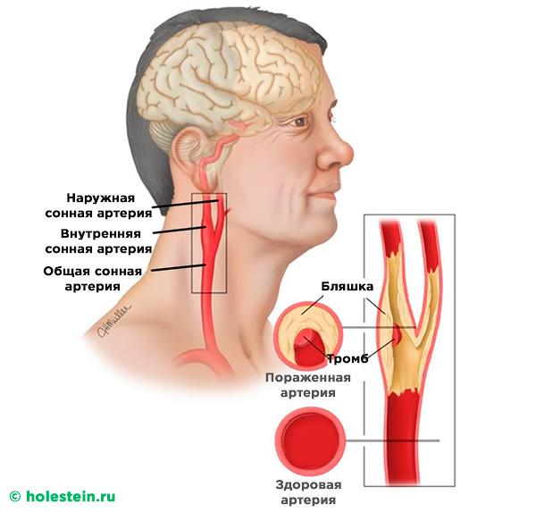 Атеросклероз сосудов сонных артерий