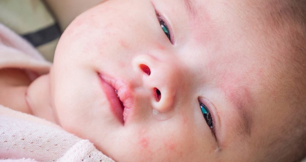 Аллергия на Аквадетрим у детей и взрослых