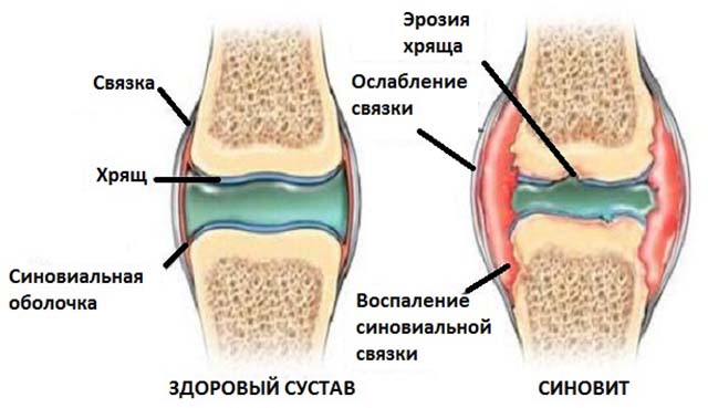 Скопление синовиальной жидкости в коленном суставе