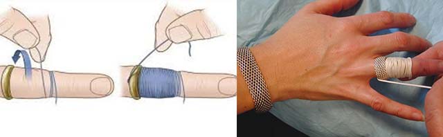 Способ снять кольцо с пальца с помощью нитки и иголки