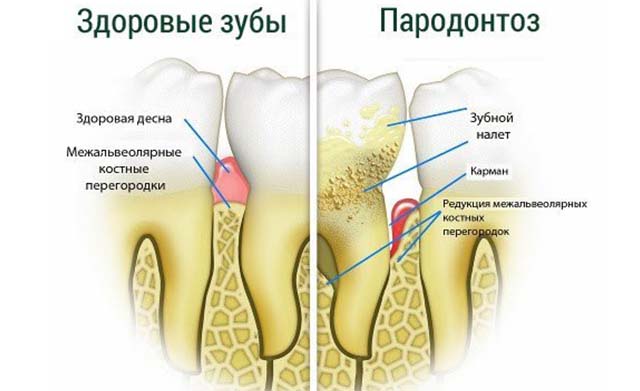 Пародонтоз и здоровый зуб