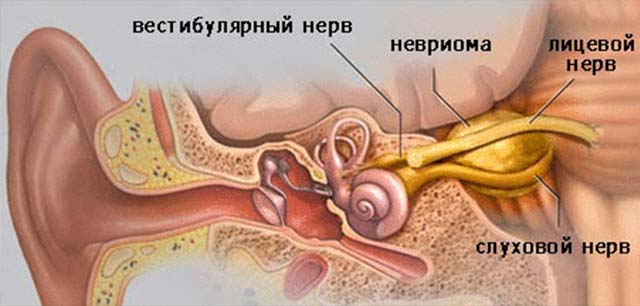 Перитонит и флегмона