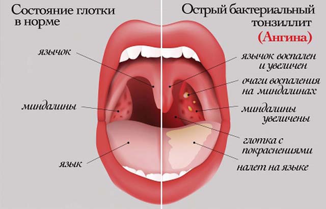 Заболевание горла при ангине