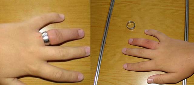 Отек пальца после снятия кольца