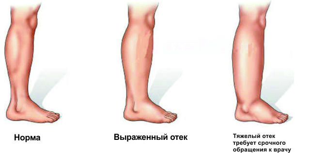 Примеры отека ног