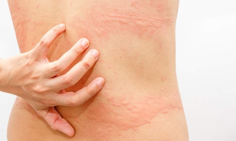 кожные проявления аллергии