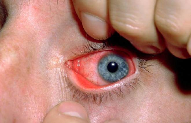 Инфекционное поражение глаза