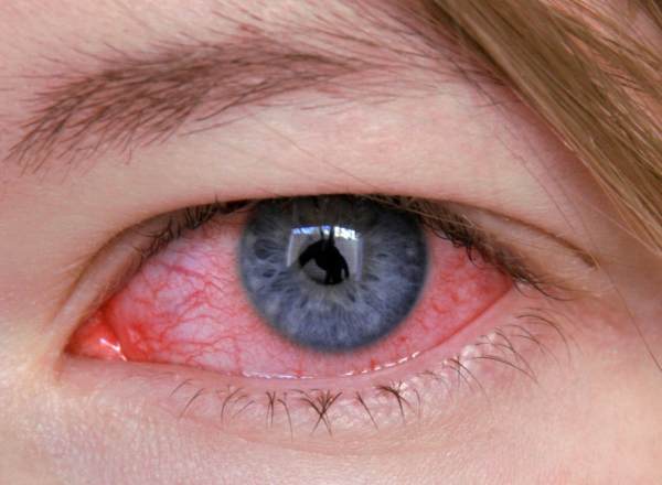 Заболевание глаза кератит