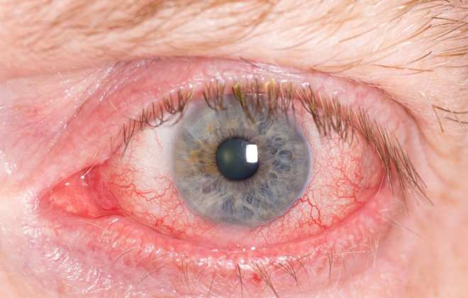 Отек и покраснение глаза при повышенном внутричерепном давлении