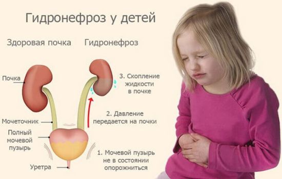 Что такое пиелоэктазия почки у ребенка, как проявляется и как лечится?