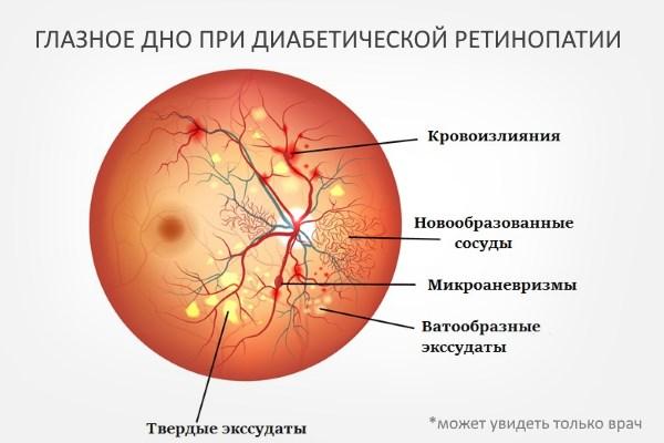 Глазное дно при ретинопатии