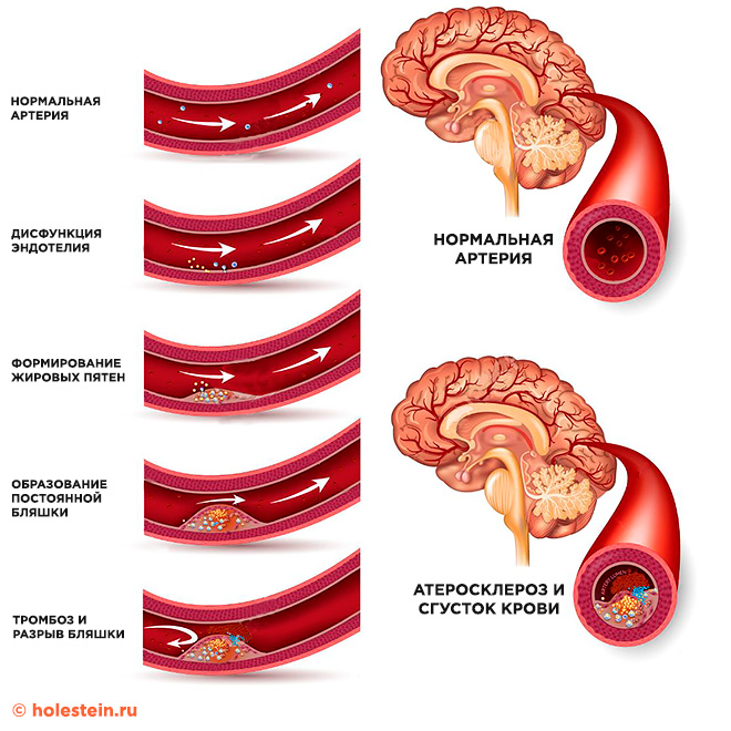 Этапы развития атеросклероза головного мозга