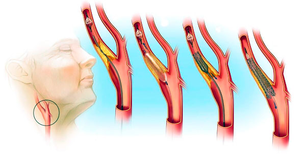Эиапы развития атеросклероза шеи