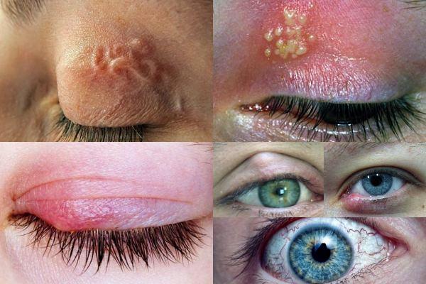 Инфекционные заболевания глаз