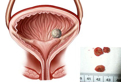 Какие симптомы заболеваний мочевого пузыря у женщин, и как их лечить?