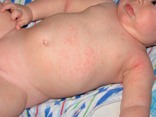 Аллергия на укропную воду у новорожденных