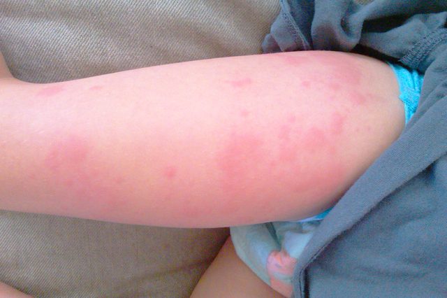 Аллергия на фруктозу
