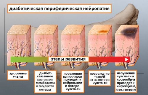 Почему немеет тазобедренный сустав: причины и лечение