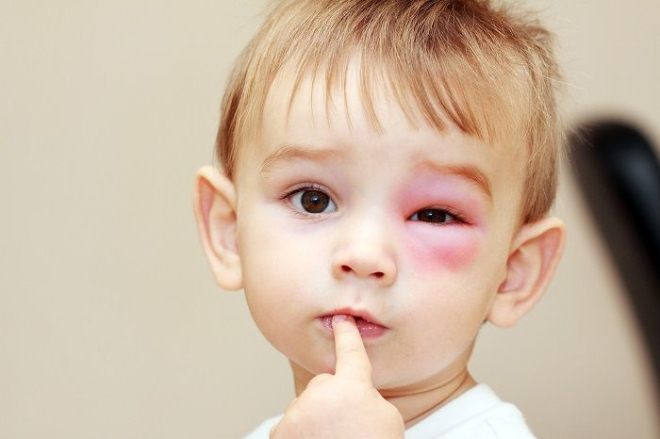 Опухший глаз при аллергии