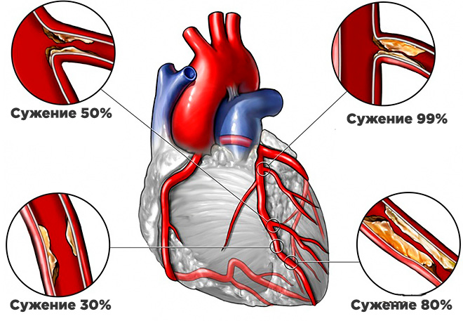 Поражение сосудов сердца атеросклерозом