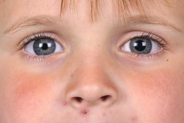 Ребенок с анизокорией глаз