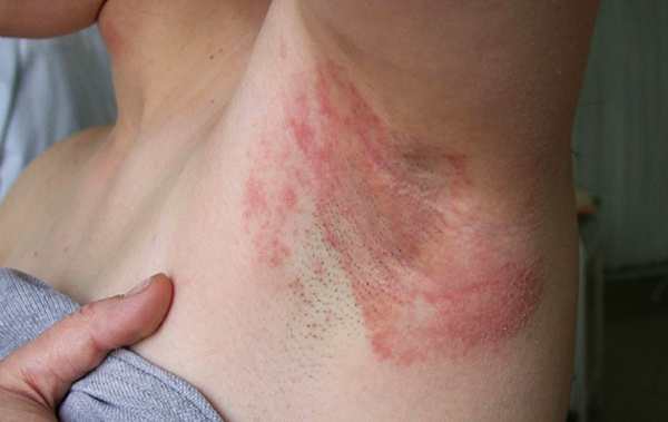 Аллергия на дезодорант