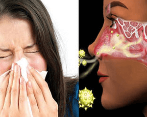 аллергический синусит симптомы
