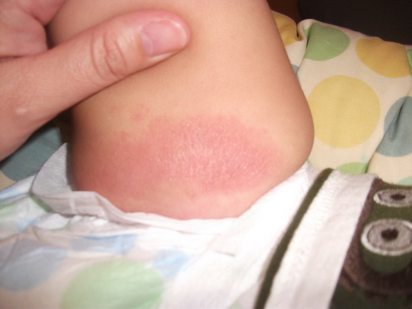 Аллергия на памперсы
