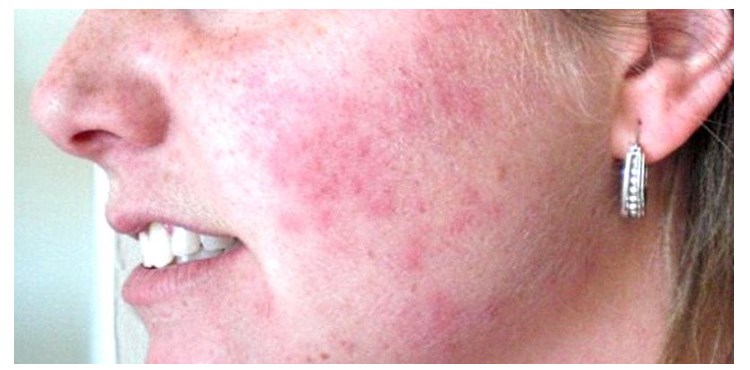 Аллергия на Гепариновую мазь
