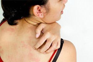 Зуд от аллергии: лечение традиционными и народными средствами