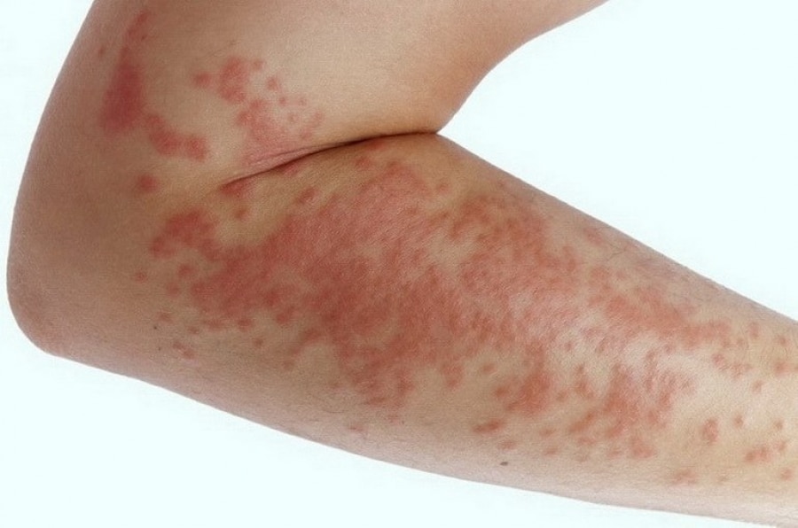 Аллергия на прополис